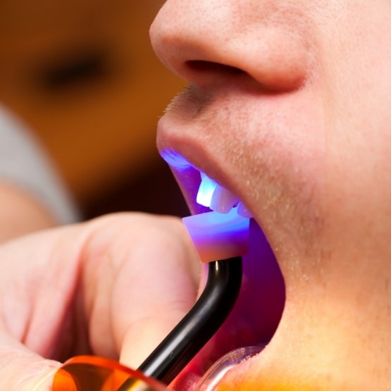 Close up of cosmetic bonding process