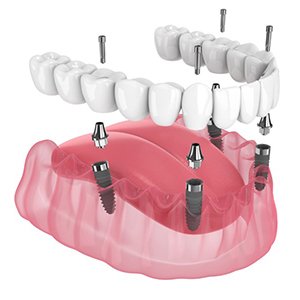 Fixed implant denture