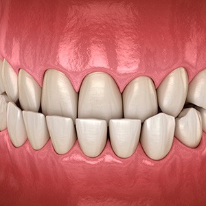 Illustration of an underbite