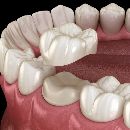 Illustration of a dental crown placed on tooth