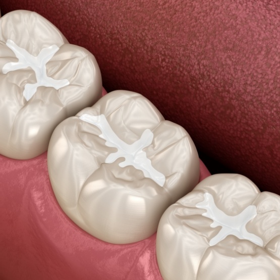 Illustration of tooth colored fillings in lower arch