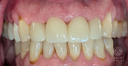 Smile after dental treatment