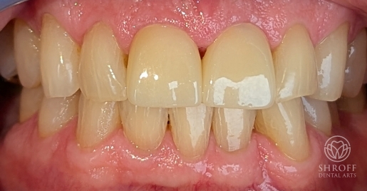 Smile after dental treatment