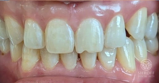 Smile after dental treatment