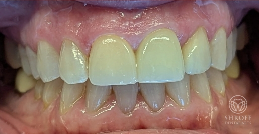 Smile after dental treatment