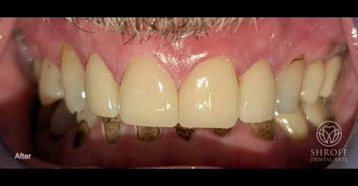 Smile after dental treatment