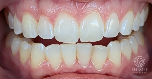 Smile after dental treatment
