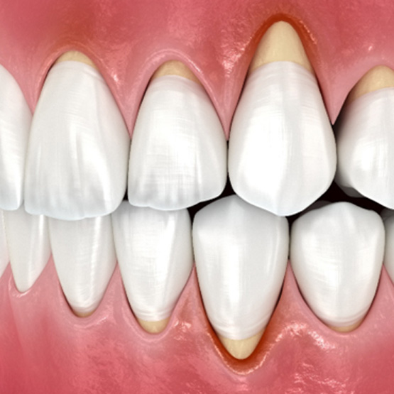 Digital view of gum recession 