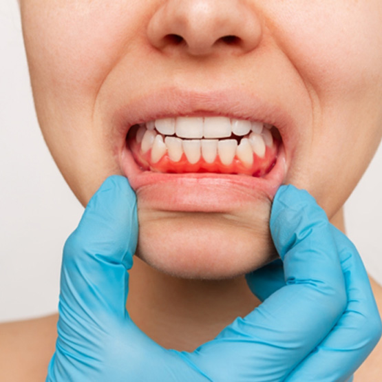 Gloved hand pulling down the bottom lip to show red gums 