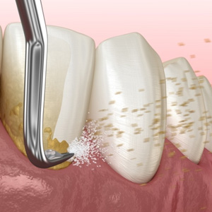Digital view of scaling and root planing 