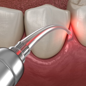 Digital view of laser periodontal treatment 