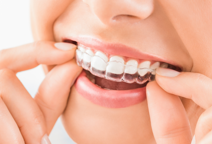 Woman putting on Invisalign